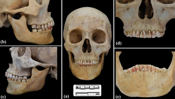 Archaeologists Discover Mysterious Red Pigment on 2,200-Year-Old Teeth