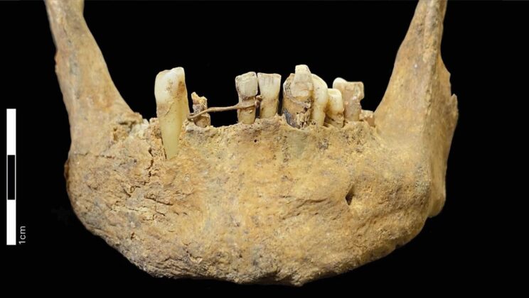 This medieval man had a gold wire tied around his teeth while he was alive
