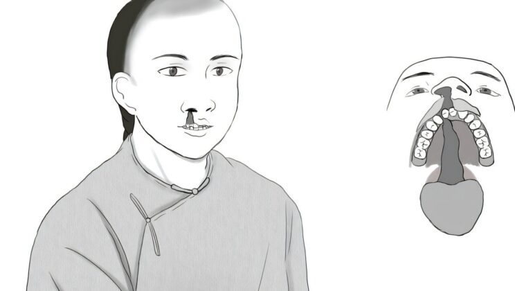 His cleft lip and palate did not keep him from family life: a 16- to 18-year-old in Qing China was buried alongside a likely wife in an ordinary family tomb