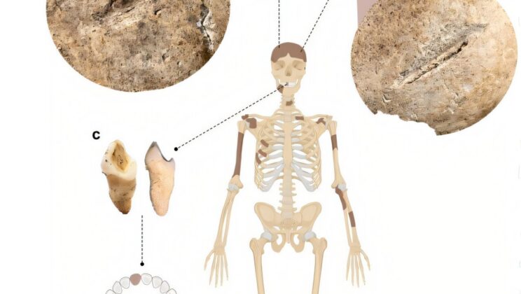 Nearly 1,400 years ago, a Langobard woman survived severe head injuries